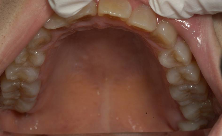 左上の歯に痛みを訴え来院されました。前から6番目の歯（第一大臼歯）がかみ合わせの部分から根元まで割れていました。