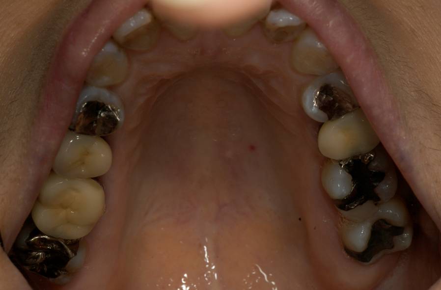 上の歯のかみ合わせの部分です