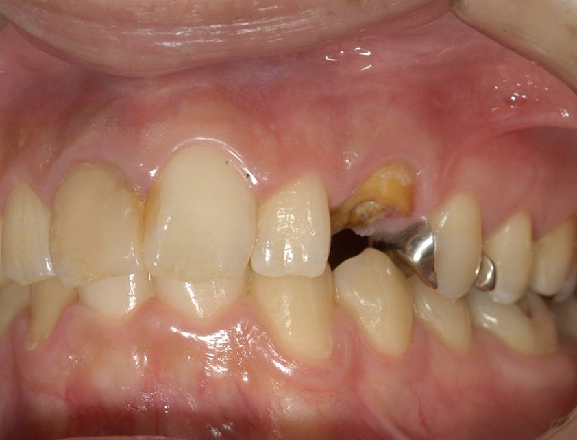 左上の犬歯がむし歯でほとんど歯が欠けたような状態で来院されました。
