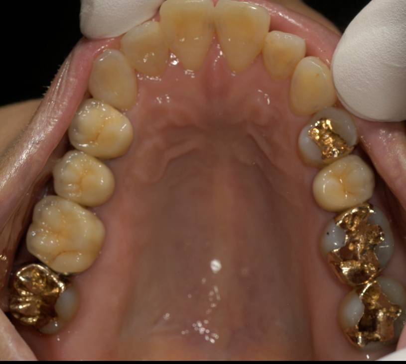 適合を重視して、見えにくい上の歯は、ゴールドインレーを選びました。歯になじみます。