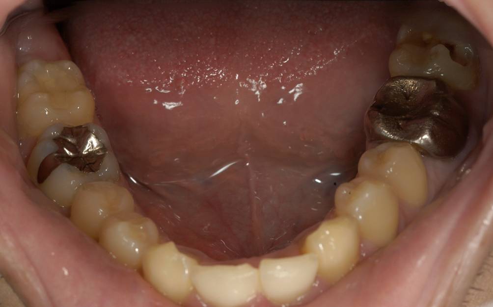 下の歯です。
左下の奥歯にも大きなむし歯があります。